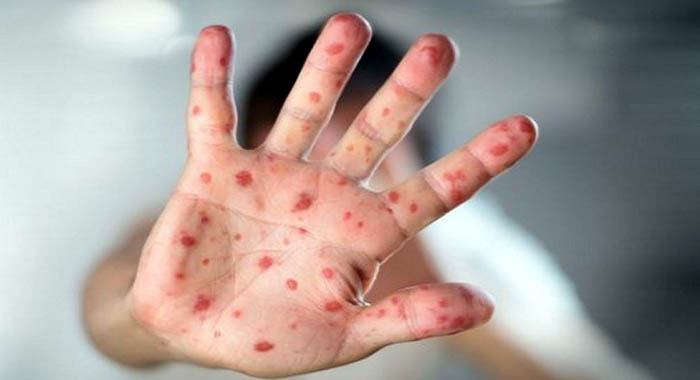 রাঙ্গামাটিতে হামে ৫ শিশুর মৃত্যু, আক্রান্ত শতাধিক