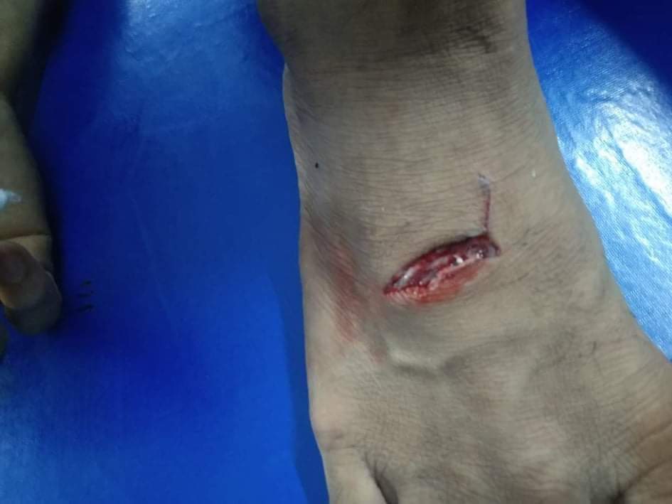 মাধবপুরে শিয়ালের কামড়ে কলেজ ছাত্র শিশু ও মহিলাসহ আহত ৭